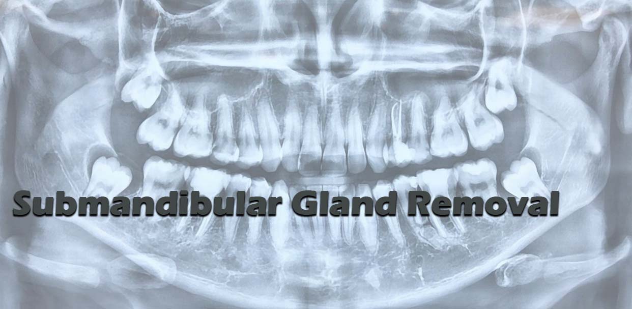 Submandibular Gland Removal